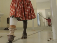 3D-Printed Prosthetics for the Developing World